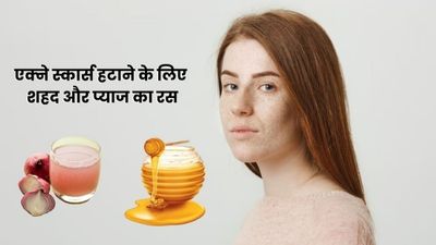 मुहांसों के दाग हटाने के लिए ऐसे लगाएं शहद और प्याज का रस, मिलेगा फायदा