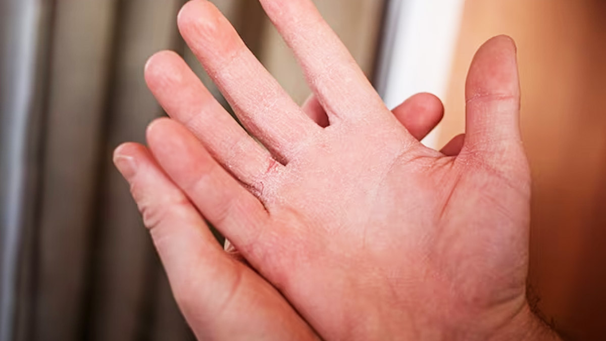 Troubled With Dry Hands? Learn Its Causes & Remedies To Treat It
