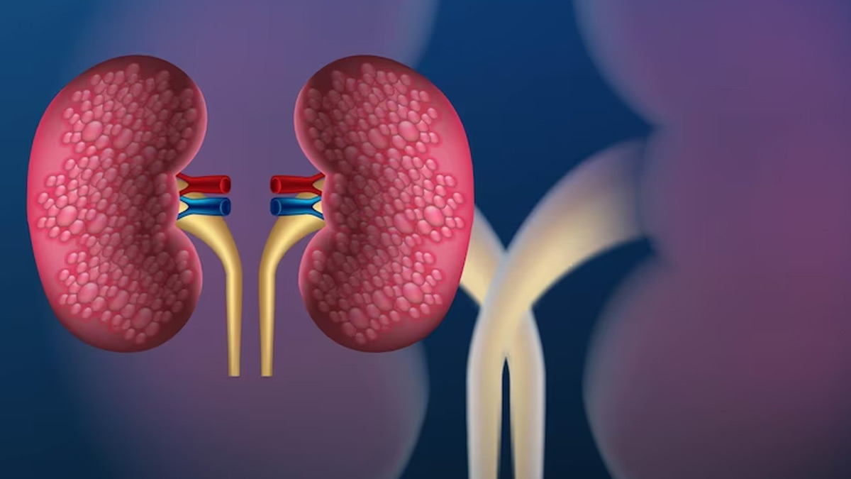 How Is Anaemia Related To Chronic Kidney Disease, Expert Weighs In