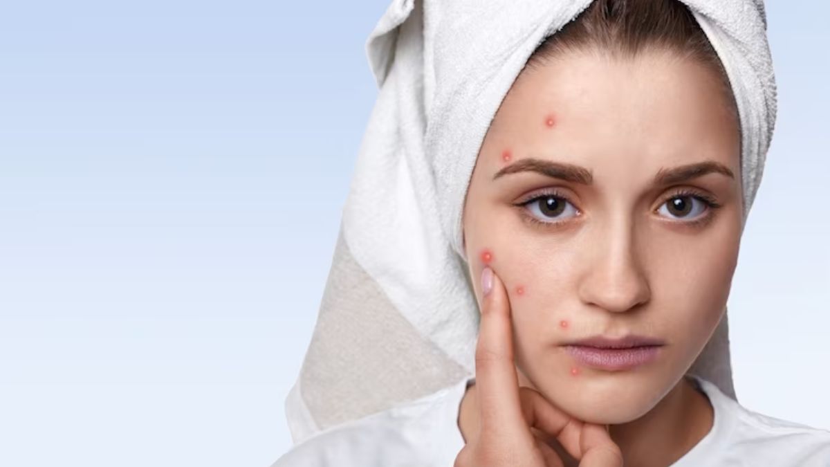 How To Remove Dark Spots Caused by Chickenpox