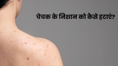 चिकनपॉक्स (चेचक) की वजह से चेहरे पर होने वाले निशान को कैसे हटाएं