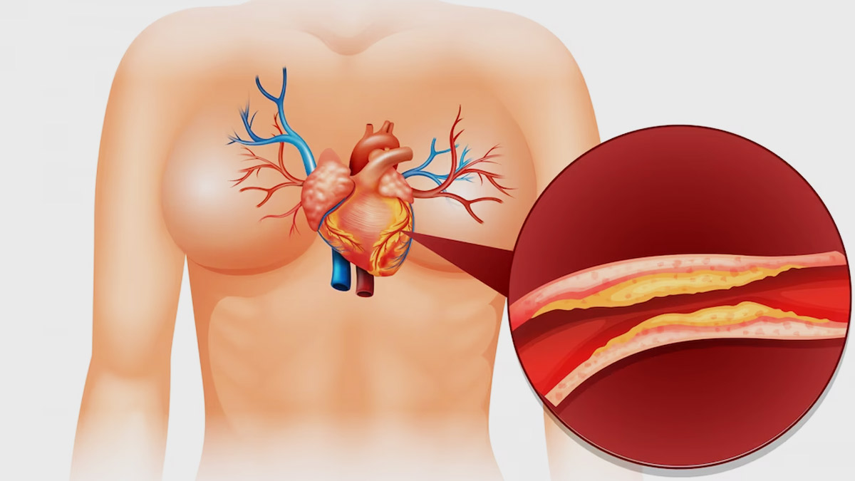 why does cholesterol increase