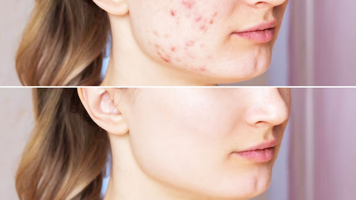 How To Remove Dark Spots Caused By Pimples in hindi