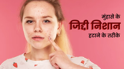 चेहरे से मुंहासों के जिद्दी निशान कैसे हटाएं? जानें 5 आसान तरीके