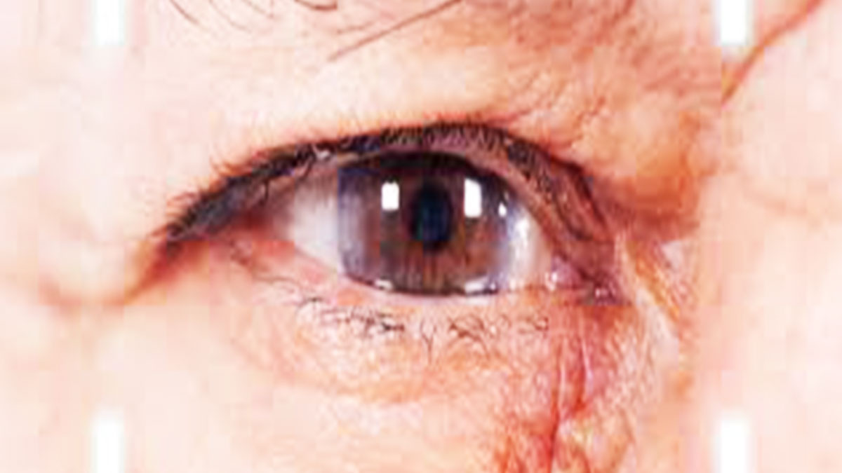 glaucoma myths and facts