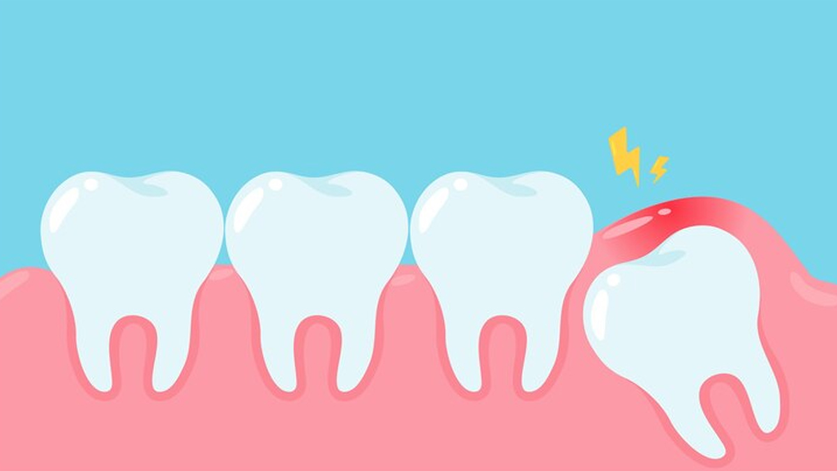 What You Can Do About Impacted Wisdom Tooth, Dentist Explains