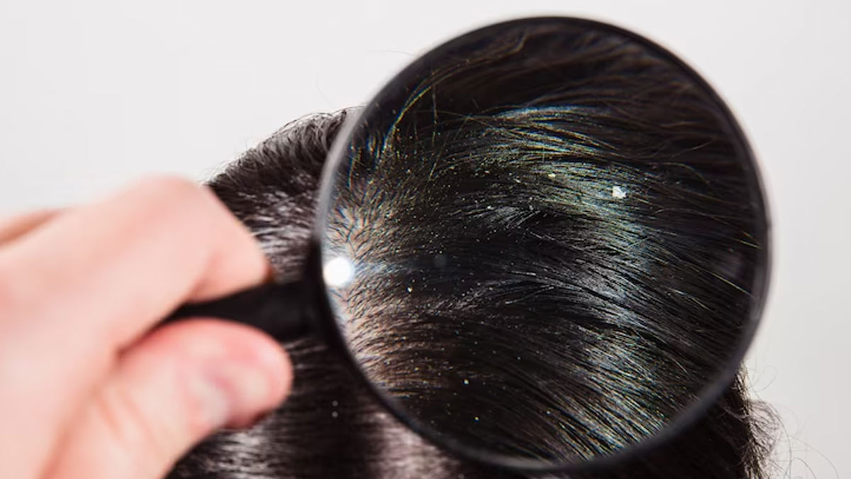 Dealing With Summer Dandruff? Here're 6 Ways To Get Rid Of It