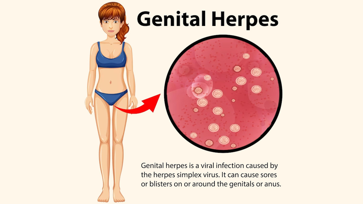 How common is herpes and Natural Ways To Manage It OnlyMyHealth