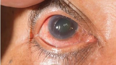 ग्लूकोमा (काला मोतिया) के मरीजों को नहीं करना चाहिए इन फूड्स का सेवन 