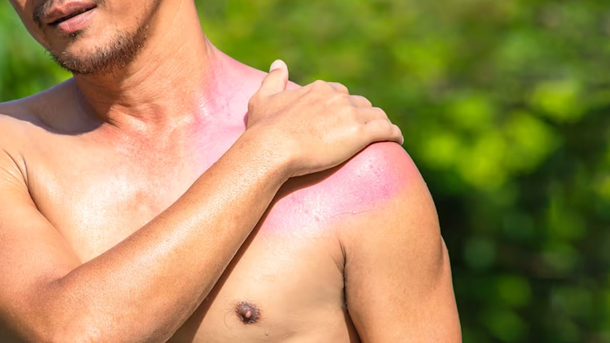 5-common-summer-skin-problems-you-must-be-watchful-of-onlymyhealth