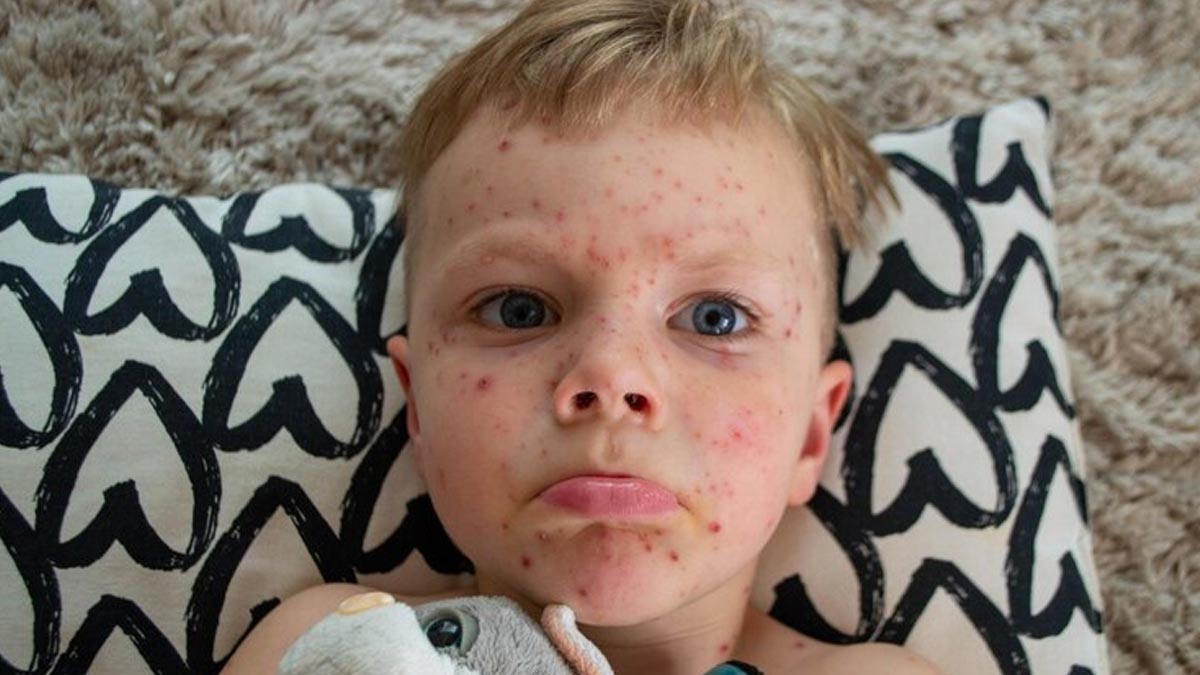 Early Symptoms & Preventive Tips For Children With Measles