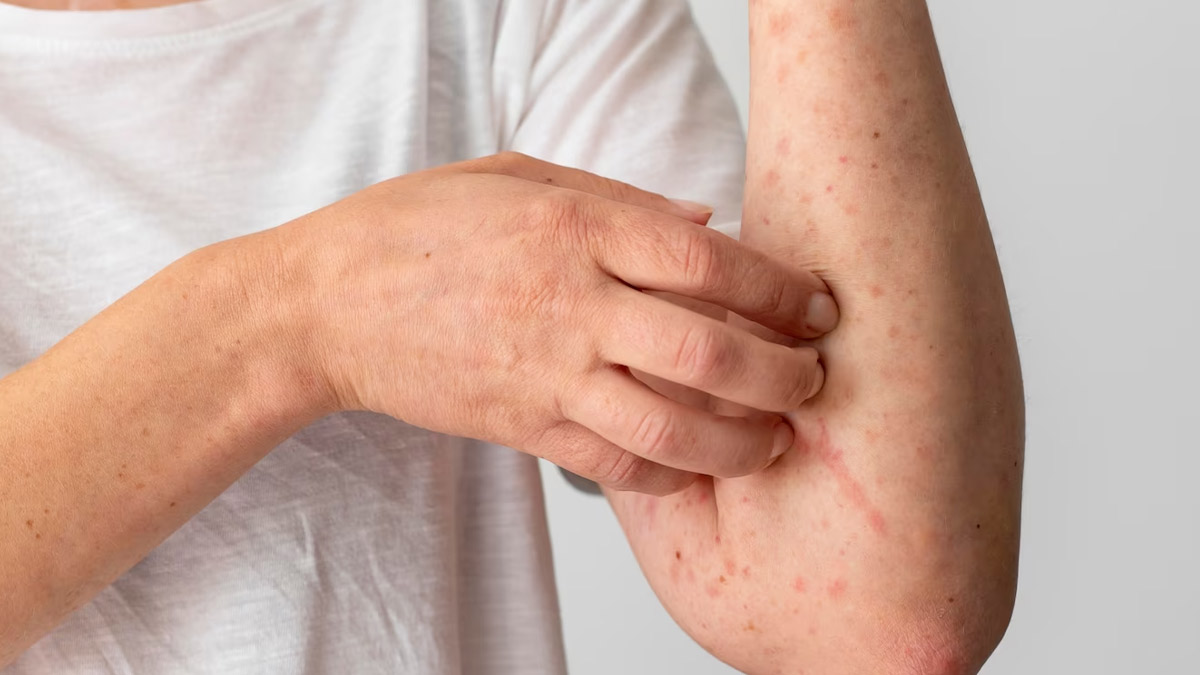 how to get relief from eczema 