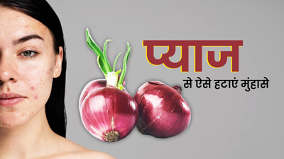 मुंहासे दूर करने के लिए इन 3 तरीकों से करें प्याज का प्रयोग, दाग-धब्बे भी होंगे साफ