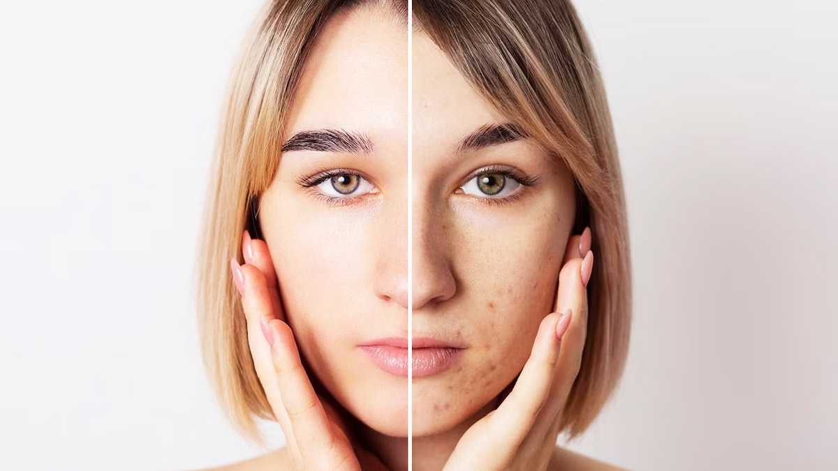 Onion To Cure Pimples In Hindi