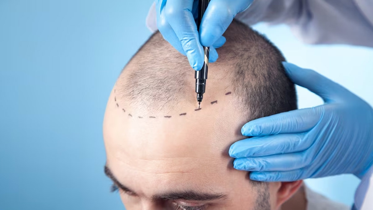 Hair Transplant Surgery Before and After Medical Center Turkey