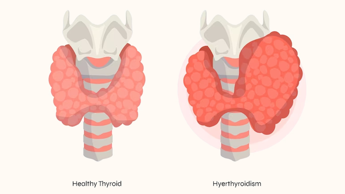 how-hyperthyroidism-affects-your-health-onlymyhealth