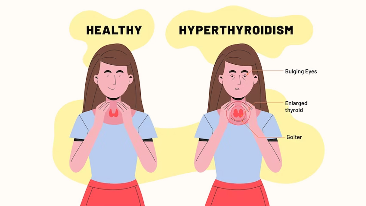  How Hyperthyroidism Affects Your Health