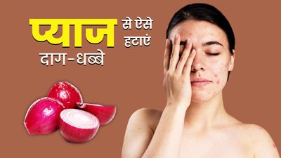 चेहरे पर इन 3 तरीकों से प्याज लगाने से साफ होते हैं दाग-धब्बे, त्वचा में भी आएगा निखार
