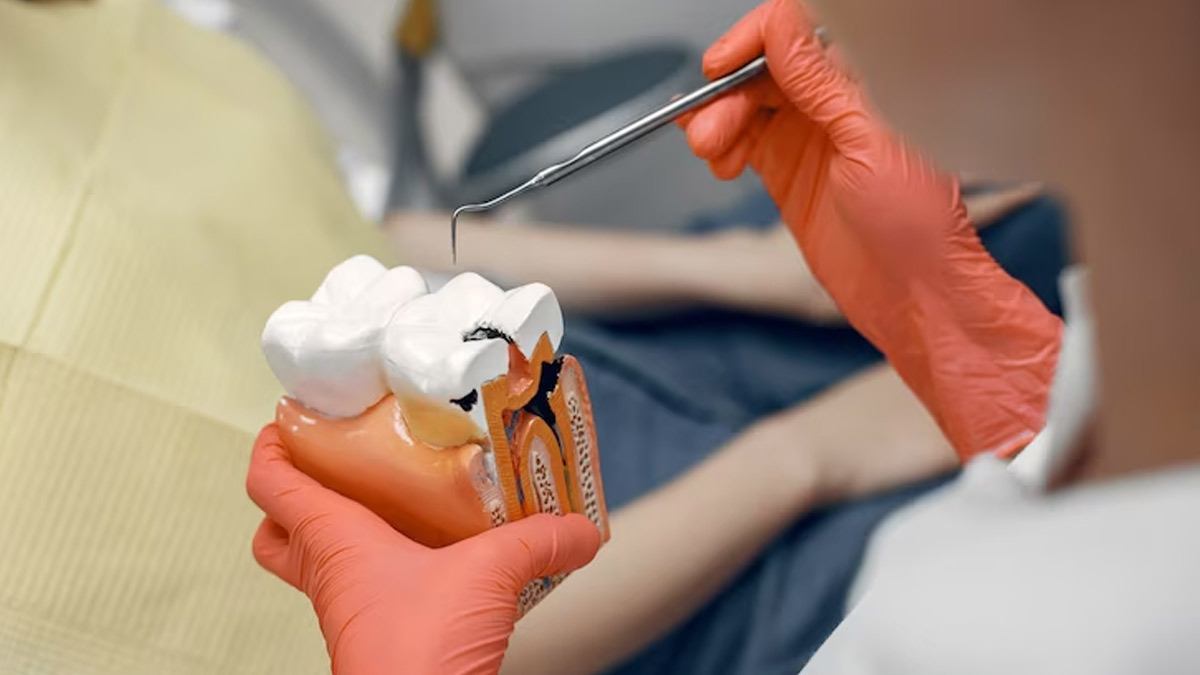 Dental Fillings: Different Types Of Filling You Should Know