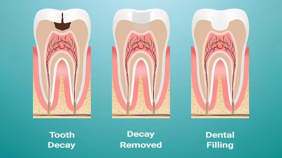 Dental Fillings Different Types Of Filling You Should Know OnlyMyHealth
