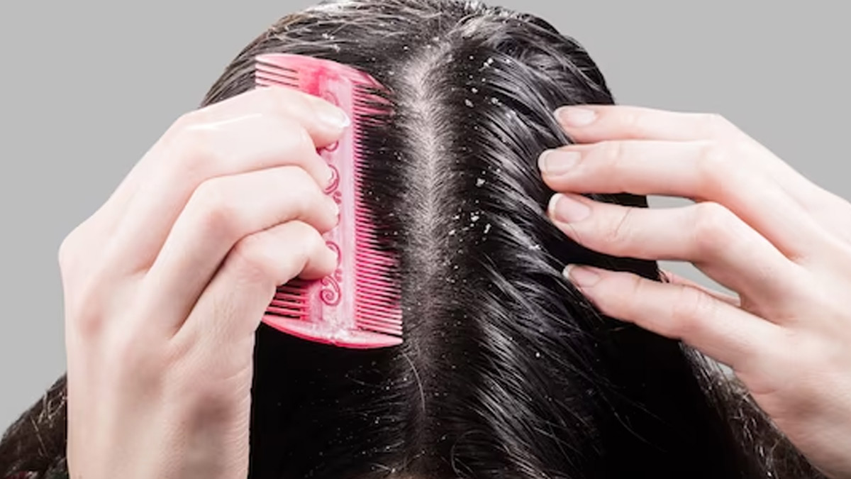 Egg White On Hair For Dandruff In Hindi