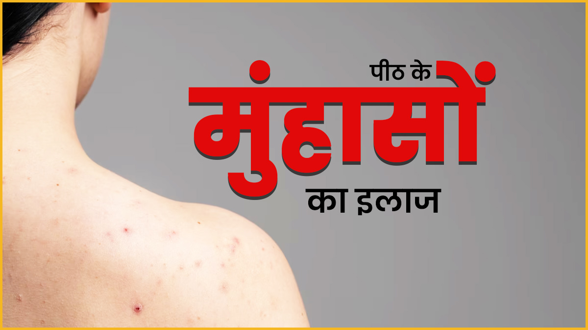 पीठ पर होने वाले मुंहासों से चाह‍िए छुटकारा, तो इस तरह इस्‍तेमाल करें टी ट्री ऑयल