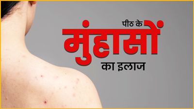पीठ पर होने वाले मुंहासों से चाह‍िए छुटकारा, तो इस तरह इस्‍तेमाल करें टी ट्री ऑयल