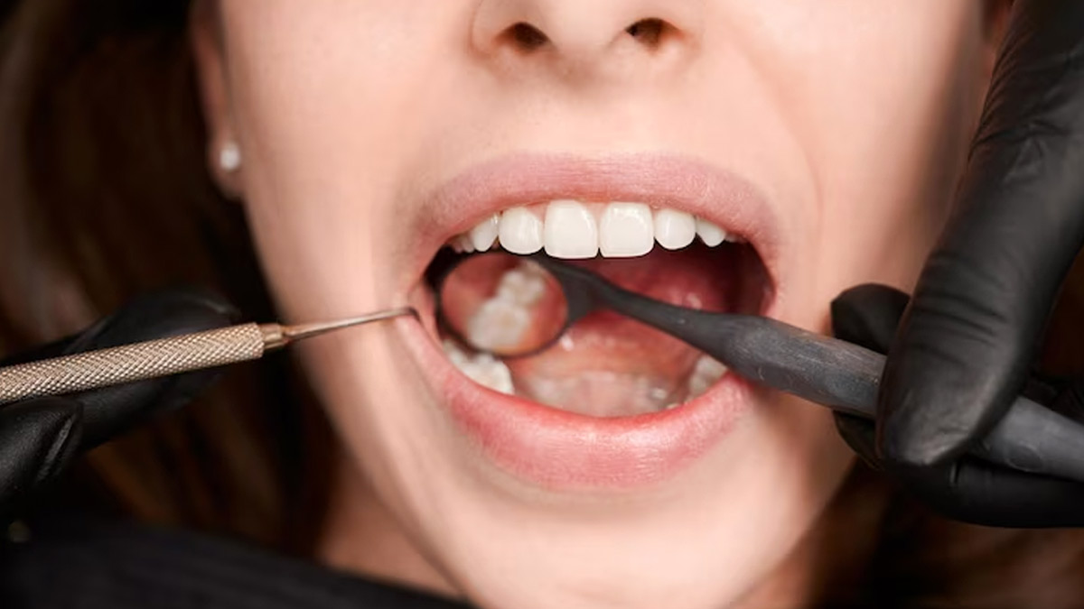 Dentist Shares Tips To Follow After Getting Dental Filling