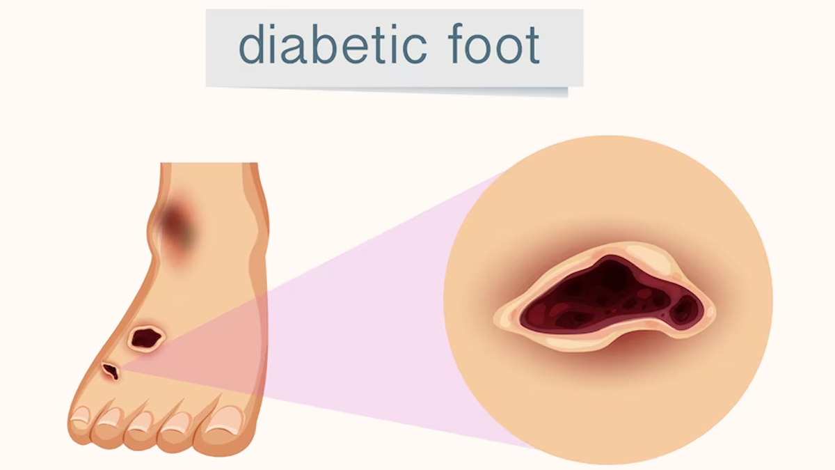 Lifestyle Modification To Prevent Diabetic Foot Ulcer