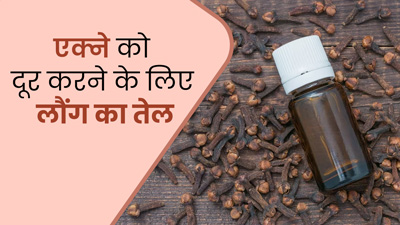 मुंहासे की समस्या दूर करने के लिए इस्तेमाल करें लौंग का तेल, जानें इस्तेमाल के तरीके