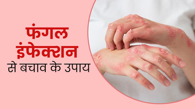 फंगल इंफेक्शन होने पर आजमाएं ये 5 घरेलू उपाय, दूर होगी खुजली और जलन की समस्या