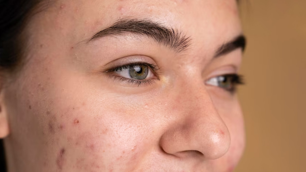 Tips To Lighten Facial Scars