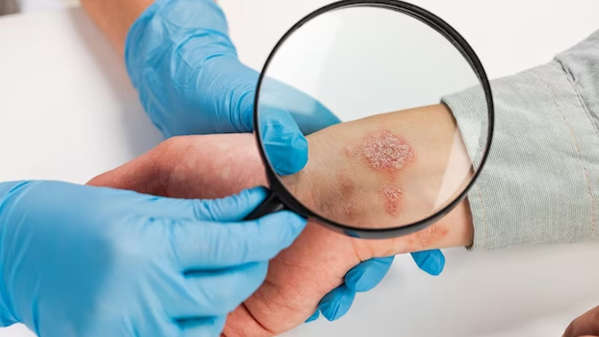 Candida-Auris-Fungal-Infections