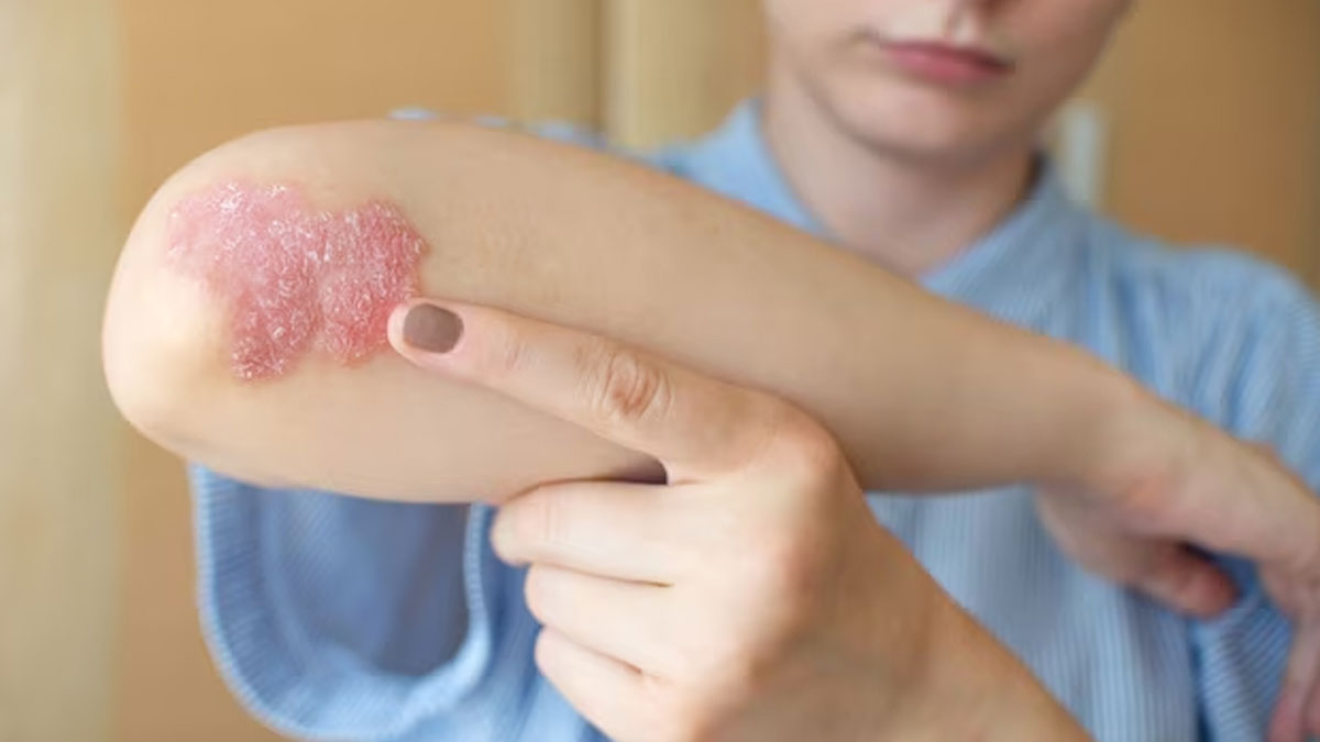 tips to manage psoriasis during summer in hindi
