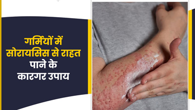गर्मी में सोरायसिस की समस्या से राहत पाने के लिए अपनाएं ये 5 उपाय