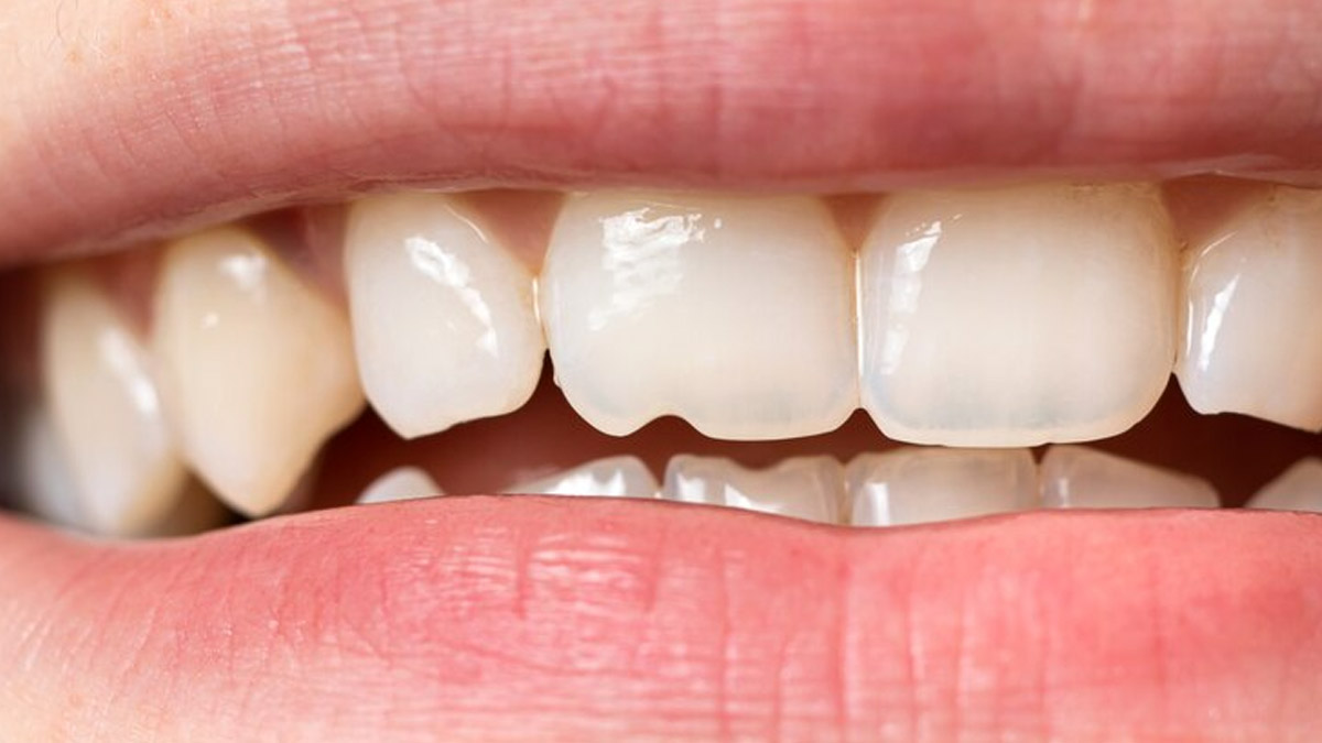 Chipped Teeth Causes Treatment