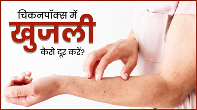 चिकनपॉक्स में होने वाली खुजली कैसे दूर करें? डॉक्‍टर से जानें 5 आसान घरेलू उपाय