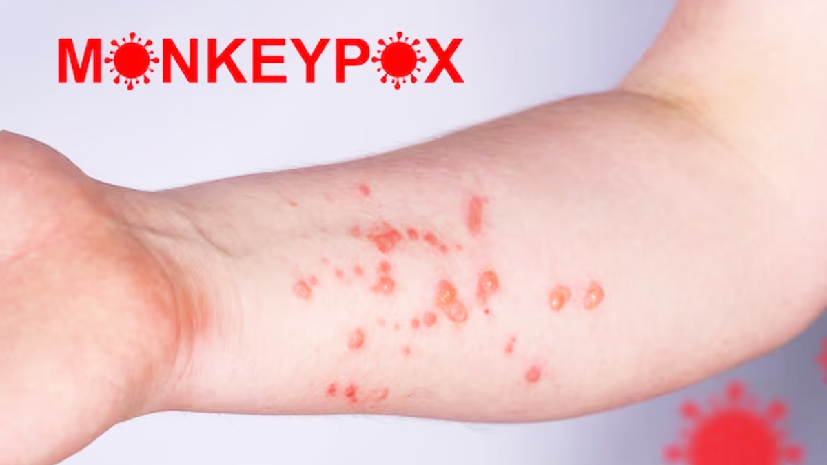 monkeypox vaccine