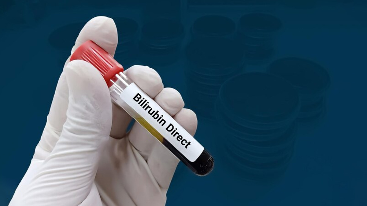 Jaundice Early Symptoms To Know OnlyMyHealth