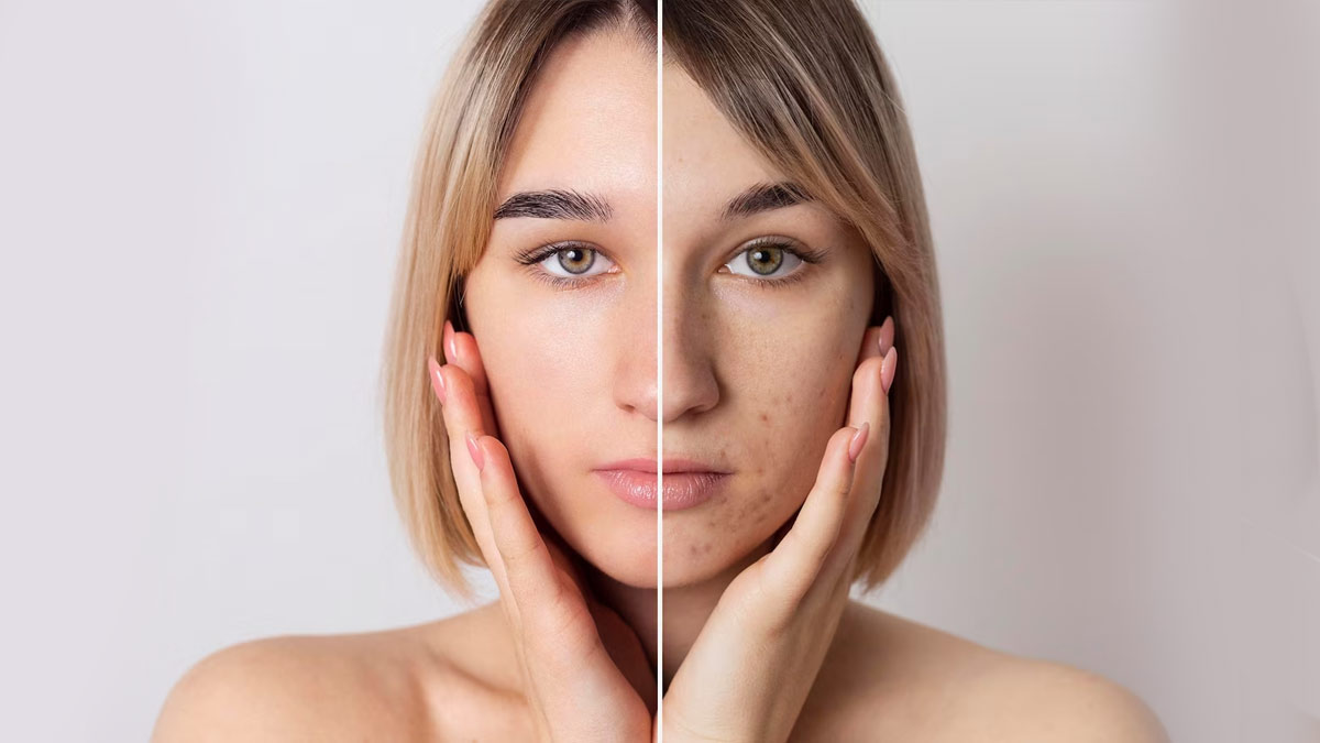 How To Remove Blackheads With Turmeric in hindi