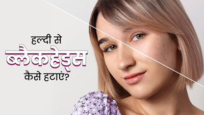 हल्दी से इस तरह हटाएं चेहरे के ब्लैकहेड्स, मिलेगी साफ और दमकती त्वचा