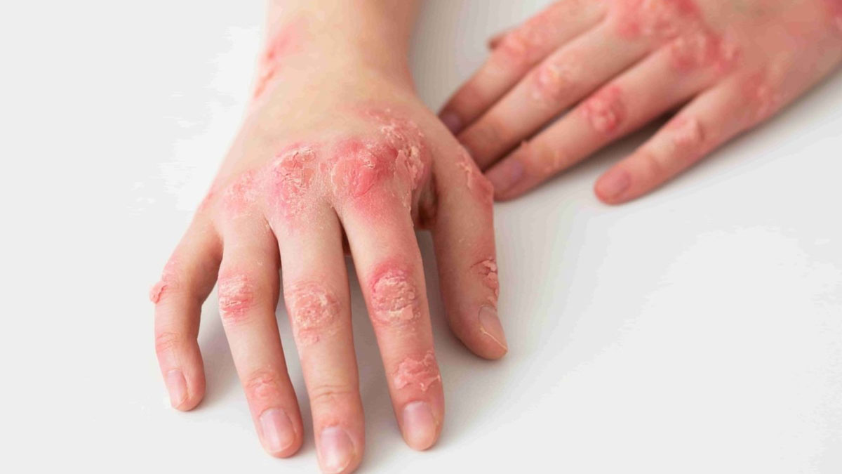 eczema symptoms