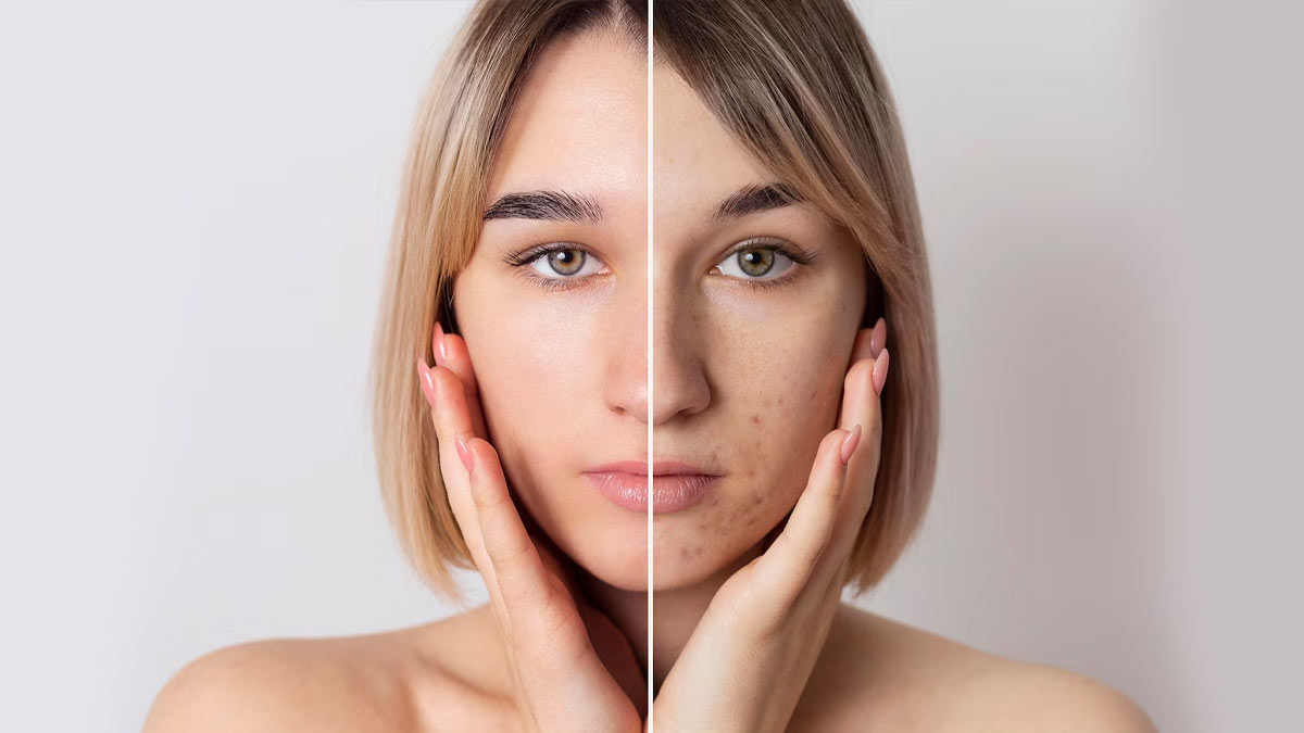 चेहरे के ओपन पोर्स हो गए हैं बड़े? रोज फॉलो करें ये 5 स्‍क‍िन केयर ट‍िप्‍स, दूर होगी समस्या