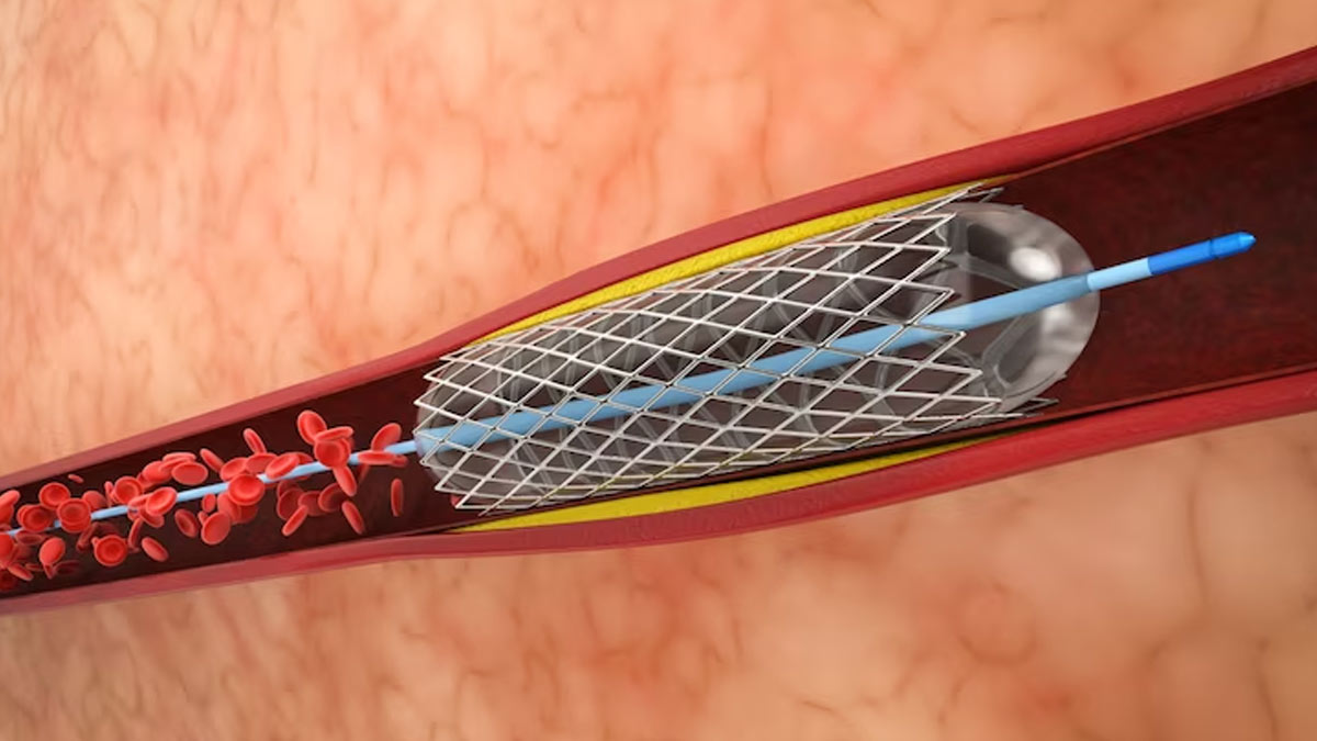 Everything You Need To Know About Getting A Stent, Cardiologist Weighs In
