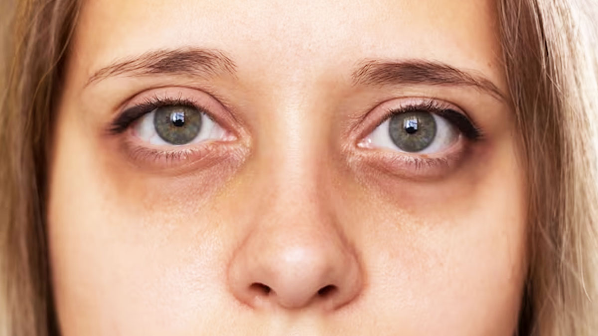 Coconut Oil For Dark Circles In hindi