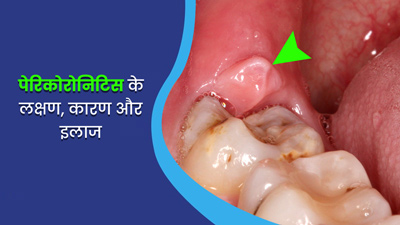 अक्ल दाढ़ के पास सूजन और पस हो सकते हैं पेरिकोरोनिटिस (Pericoronitis) के लक्षण, जानें कारण और इलाज