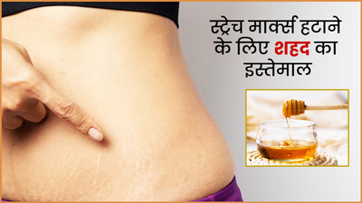 जिद्दी स्ट्रेच मार्क्स को हटाने में फायदेमंद है शहद, इन 4 तरीकों से करें इस्तेमाल