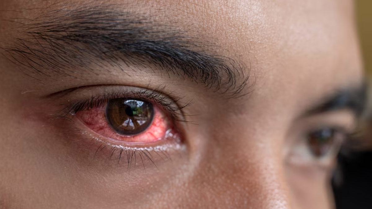 Are You Suffering From The Bloodshot Eyes: Here Are Five Home Remedies To Treat It
