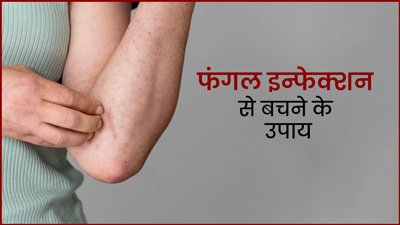 बिन मौसम बरसात के कारण बढ़ रहे हैं फंगल इन्‍फेक्शन के मामले, डॉक्टर ने बताए सुरक्षित रहने के टिप्स