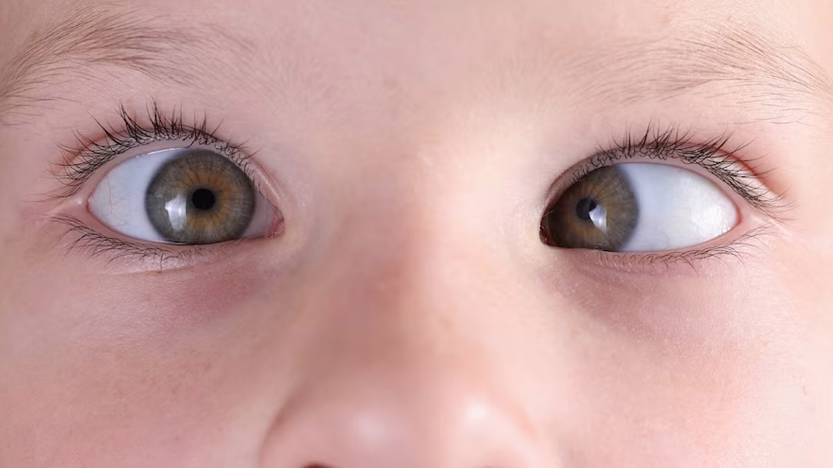 Eyes Do Not Align Properly Expert Explains Squint Eyes Its Causes And Treatment Measures